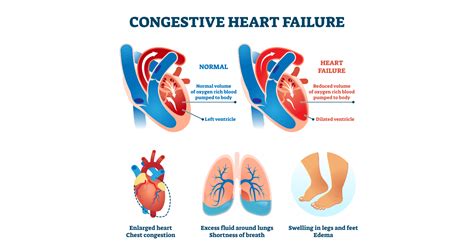 Congestive Heart Failure Symptoms Causes Types And Treatments