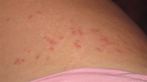 Small Red Bumps On Skin Dorothee Padraig South West Skin