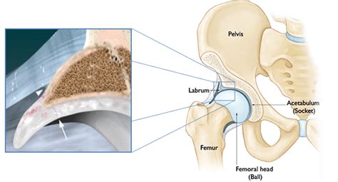 Tearing of the labrum can be found in shoulders of all age groups. hip-diagram-LABRAL TEAR - Forte Sports