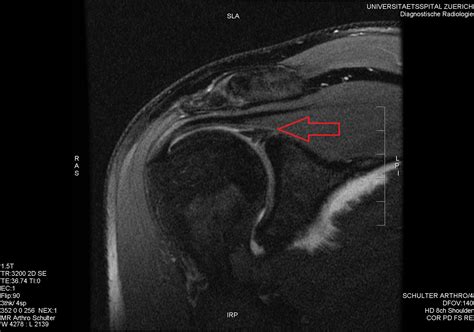 Shoulder Labrum Tear And Choosing Surgery Personal Experience