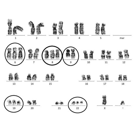 Extra Philadelphia Chromosomal Karyotype With Gain Of Chromosome 6 8