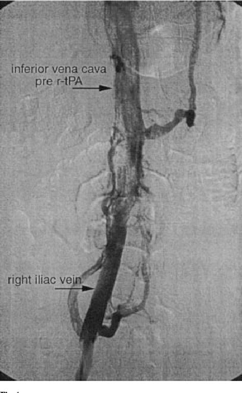 Figure 1 From Acute Inferior Vena Cava Thrombosis In A Patient With