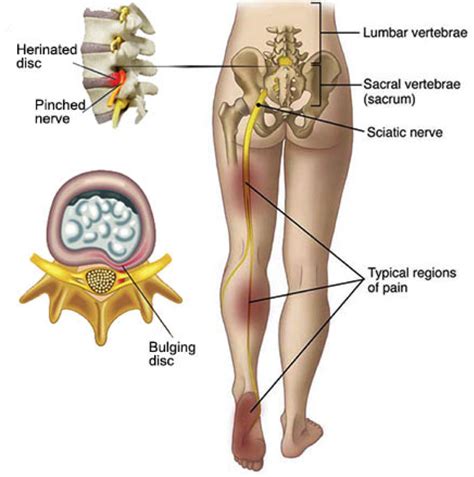 Sciatica Causes And Treatments