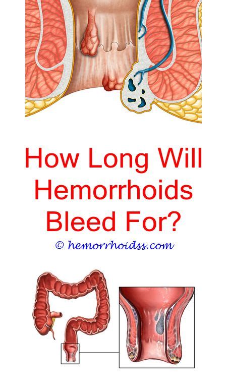 What Doctor Treats Hemorrhoids Bleeding Hemorrhoids Getting Rid Of Hemorrhoids Hemorrhoids