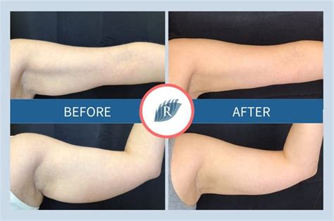 Bare Your Arms Confidently With Coolsculpting® The Refinery Skin Clinic