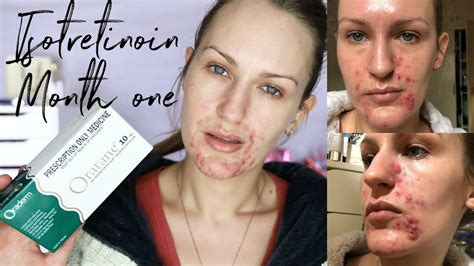 Isotretinoin Diaries Month 1 Because Acne Sucks Youtube