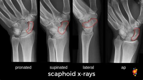 Scaphoid Fractures Laptrinhx News