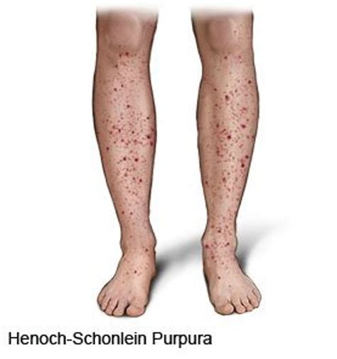 Çocuk Hastalıkları Küçük Damar İltihabı Henoch Schönlein Purpurası