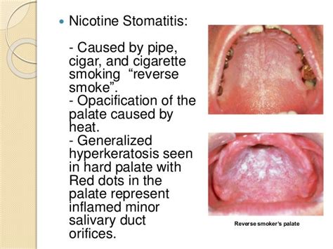 Keratosis And Related Disorder Of The Oral Mucosa