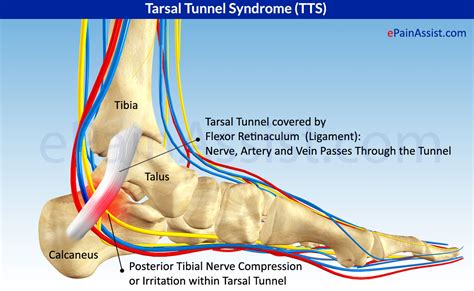 What Is Tarsal Tunnel Syndrome Tts Or Posterior Tibial Neuralgia