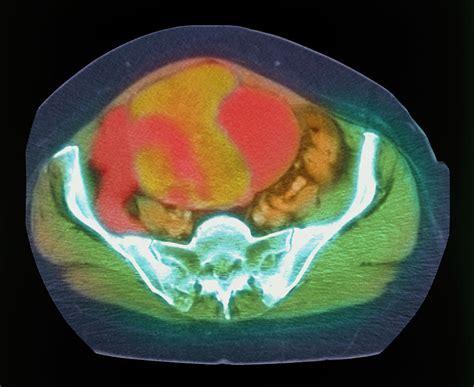 Coloured Mri Scan Of Ovarian Cancer Photograph By Science Photo Library