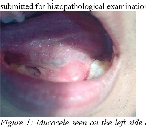 Figure 1 From Salivary Cyst Of Floor Of Mouth A Case Report
