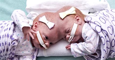 A Year After Being Separated Conjoined Twins Celebrate Their New Lives Sexiz Pix
