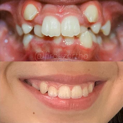 Invisalign Before And After Firouz Orthodontics West Los Angeles