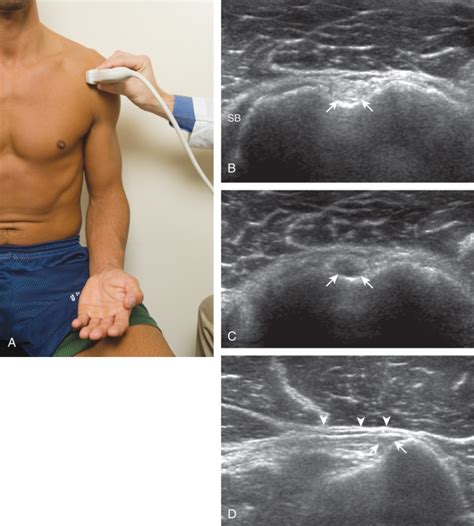 Shoulder Ultrasound Radiology Key