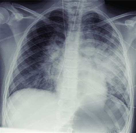 Initial Chest X Ray Of A 12 Year Old Boy With Takotsubo Cardiomyopathy