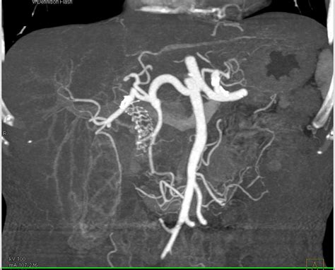 Stent In Common Bile Duct With Patent Arterial Map Vascular Case