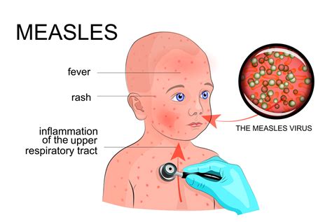 Measles In Children Baby Hints And Tips