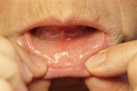 10 Primary Symptoms And Treatments Of Dry Mouth Syndrome Facty Health