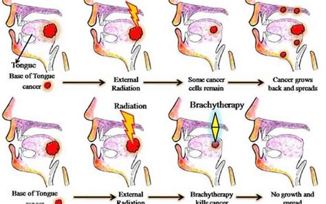 Effective Treatment Of Tongue Cancer With Brachytherapy A Complicated