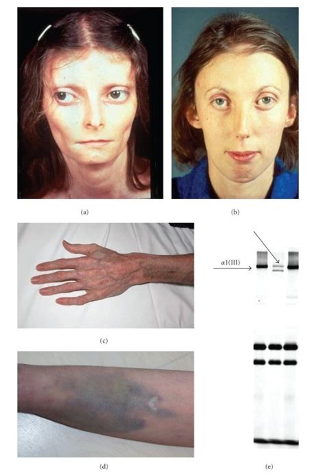 Clinical And Biochemical Characteristics Of The Vascular Ehlers Danlos