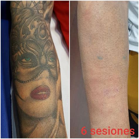 Sintético 90 Foto Eliminación De Tatuajes Antes Y Después Actualizar