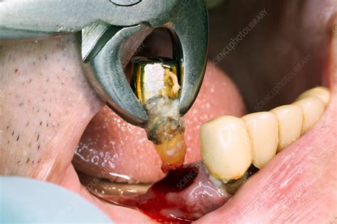 Premolar Tooth Extraction Stock Image C0298557 Science Photo Library