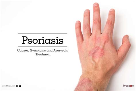 Psoriasis Causes Symptoms And Ayurvedic Treatment By Dr