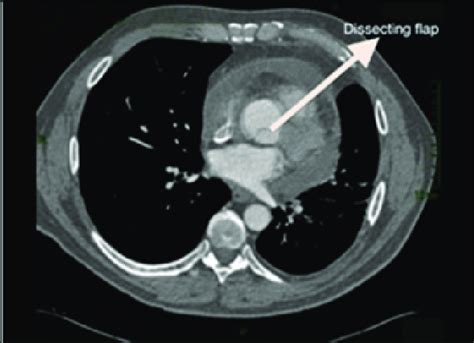 Ct Showing Dissection In Ascending Portion Of The Thoracic Aorta