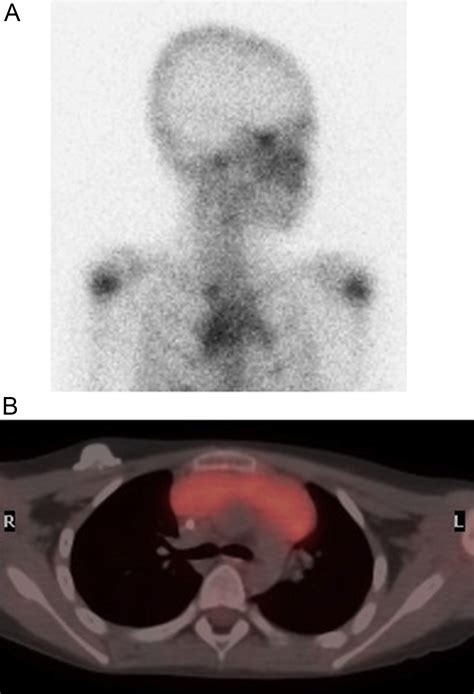 Rebound Thymic Hyperplasia After Chemotherapy In Children With Lymphoma