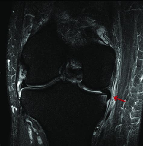 Coronal T2 Weighted Magnetic Resonance Image Of A Right Knee Showing An