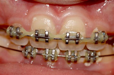 However, there is a certain age range that would be ideal to get braces, and that is between 12 and 16 years of age. 10 Important Things to Know Before You Get Dental Braces