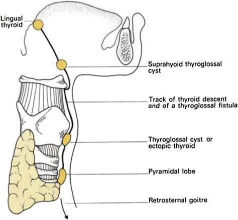 Sites Of Ectopic Thyroid Localization Along Its Descending Pathway