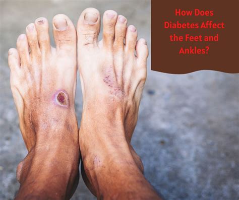 How Does Diabetes Affect The Feet And Ankles Dr Chetan Oswal Pune