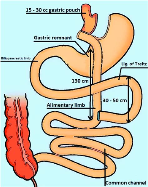 Roux En Y Gastric Bypass Side To Side Jejunojejunostomy Is Performed