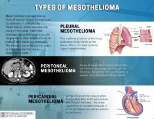What types of mesothelioma are there? Philadelphia Mesothelioma Lawyers | New Jersey Asbestos ...