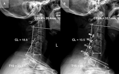 Frontiers Changes In T1 Slope And Cervical Sagittal Vertical Axis