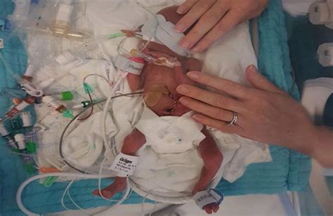 Premature Baby Born At 24 Weeks Weighed Less Than A Can Of Beans Look