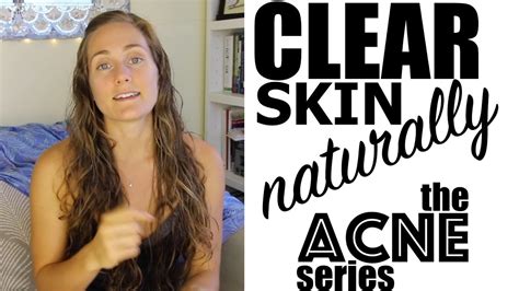 Cure Chronic Acne Naturally Part 1 Diet Exercise Lifestyle The