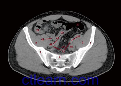 Anatomy Ct Axial Abdomen And Pelvis Male