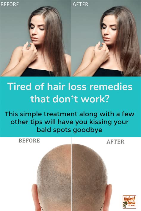 Here are the ways to treat and relieve this unpleasant condition. Coconut Oil For Hair Loss | Hybrid Rasta Mama