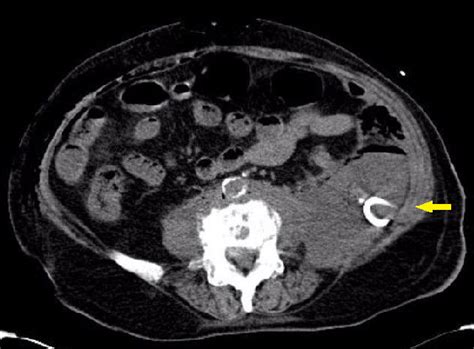 Ncct Abdomen Showing Bilateral Psoas Abscess With Pigtail In Situ On
