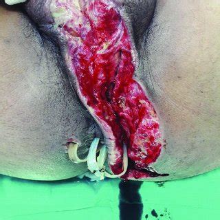 We did not find results for: The scrotum was covered by a split-thickness skin graft ...