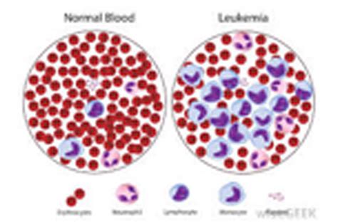 Low White Blood Cell Count