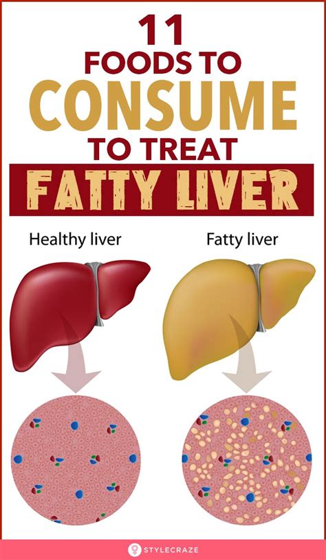 Evidence Based Fatty Liver Diet Diet Plan And Foods To Eat And Avoid