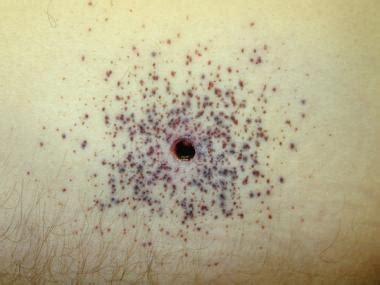 Gunshot wounds are complex, violent, traumatic injuries commonly encountered in forensic practice. Forensic Pathology of Firearm Wounds: Overview, Modern ...