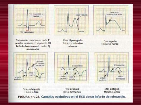 Infarto agudo do miocárdio é necrose miocárdica resultante de obstrução aguda de uma artéria coronária. My Clips por Hebert Ruvalcaba Altamirano