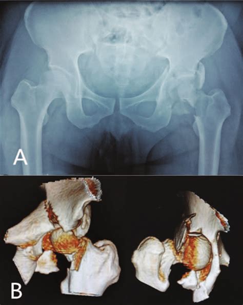 A Anteroposterior X Ray Image Of The Pelvis B Anteroposterior