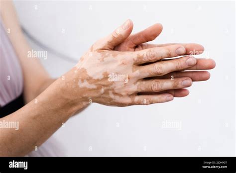 Hands With Vitiligo Skin Pigmentation On White Background Close Up