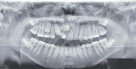 12 Year Old Boy With 2 Buccally Impacted Teeth 13 And 11 After The